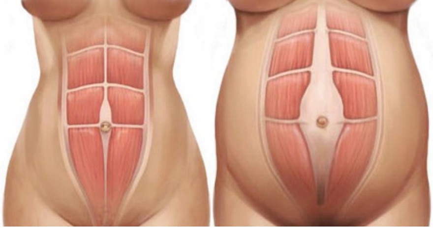 diastasis